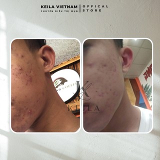 Kem Giảm Mụn KEILA