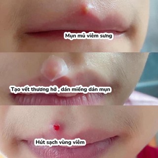 Dán Mụn COSRX Acne Pimple Master Patch 24 miếng