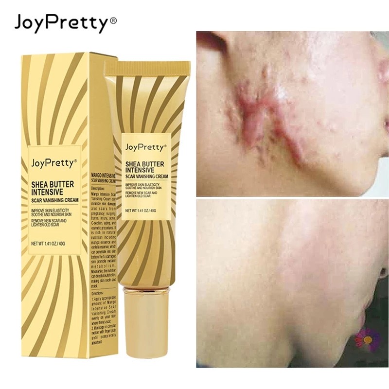 Kem mờ sẹo JoyPretty xóa sẹo hiệu quả nhất cho mặt sửa chữa, lồi, lõm, rỗ, giảm mụn, bỏng, giảm thâm mắt 40g