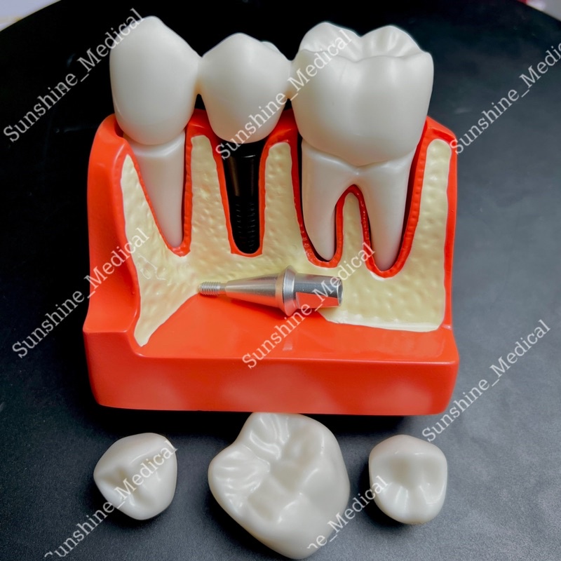 Mẫu hàm tư vấn cầu răng và implant mẫu hàm tư vấn nha khoa
