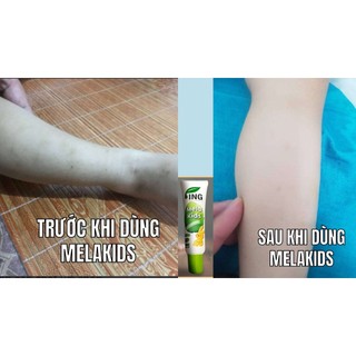 Serum mela kids làm mờ sẹo thâm, sẹo do muỗi đốt, sẹo do mụn thâm, các vết thâm khác