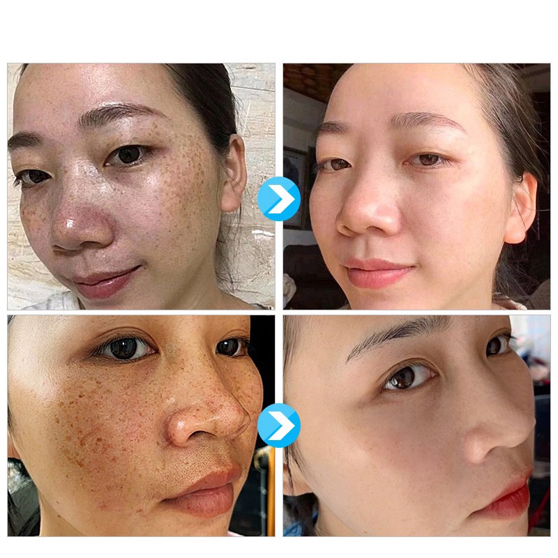 Tinh chất làm trắng sạch tàn nhang 100ml Kem trắng da và xóa tàn nhang, Hiệu quả làm mờ thâm nám tàn nha