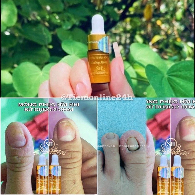 Serum nấm móng ,bọng, hư khóe móng SH
