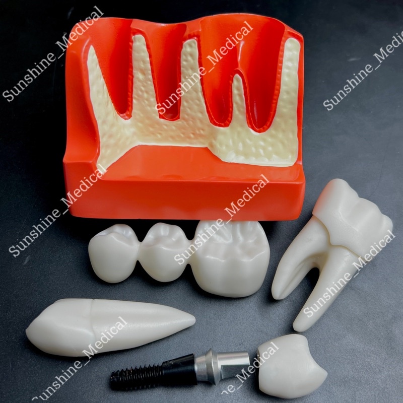 Mẫu hàm tư vấn cầu răng và implant mẫu hàm tư vấn nha khoa