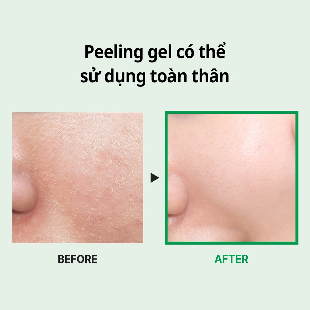 Gel loại bỏ tế bào chết MEDIPEEL Phyto Cica-Nol B5 Aha Bha Vitamin Calming Peeling Gel 120ml hỗ trợ giảm mụn