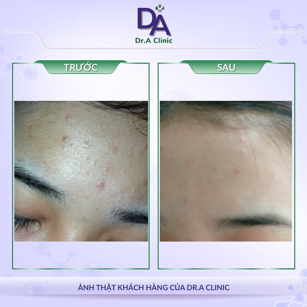 Kem chấm mụn Benzac AC 5% và 2.5% chính hãng Dr.A chứa Benzoyl Peroxide giảm mụn viêm sưng đỏ nhanh gọn