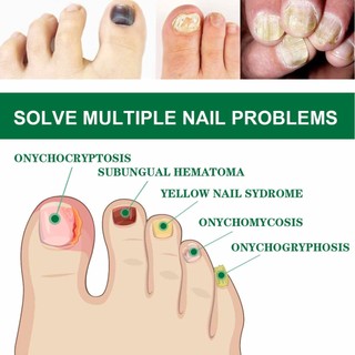 Tinh chất phục hồi chăm sóc móng hư tổn