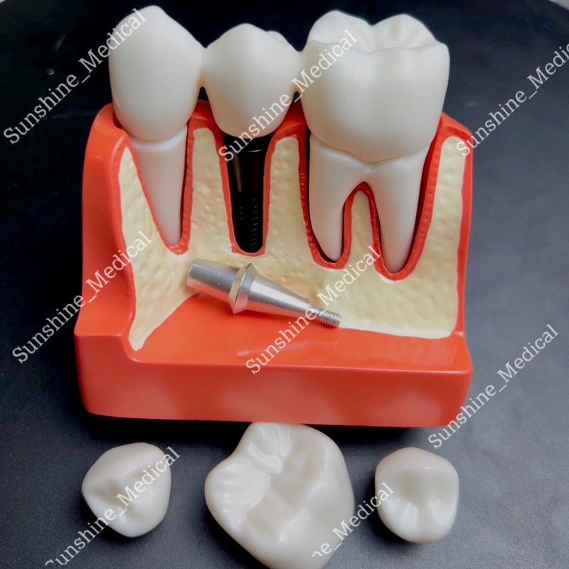 Mẫu hàm tư vấn cầu răng và implant mẫu hàm tư vấn nha khoa