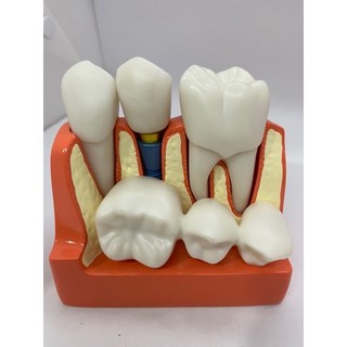 Mô hình nha khoa tư vấn implant và cầu răng