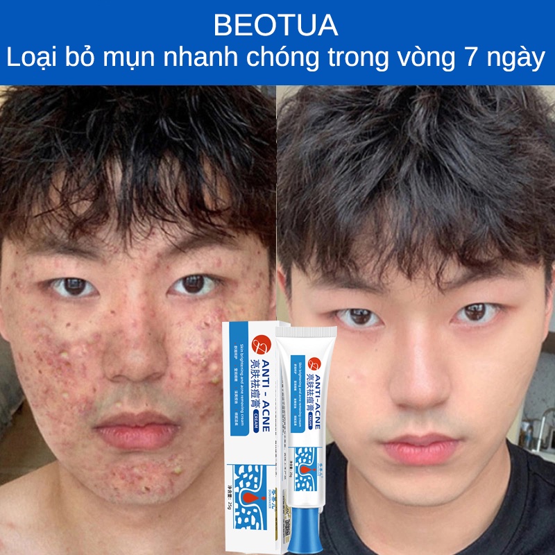Kem chấm mụn cấp tốc 30ml loại bỏ các loại mụn, mụn đầu đen, mụn ở tuổi dậy thì, loại bỏ mụn bọc cho da dầu