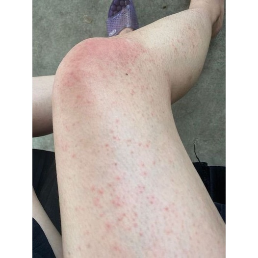 Thảo dược đánh bay Viêm lỗ chân lông, Da sần sùi, thô ráp, Lông quặp , Viêm nang lông