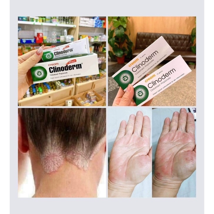 Kem bôi vảy n.ến, khô da Clinoderm Thái Lan tuýp 15g
