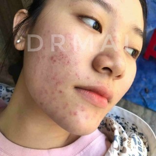 SERUM DR MAI TRI MỤN THÂM ( chính hãng )