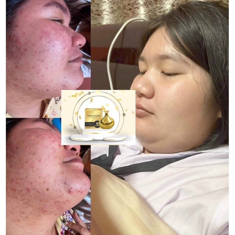 Kem Mụn Bamboo tặng sữa rửa mặt hoa gạo bamboo