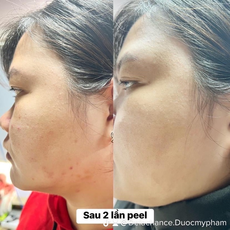 Tinh chất Home Peel cho da mụn, thâm nám, da nhạy cảm, giúp căng bóng trẻ hoá da