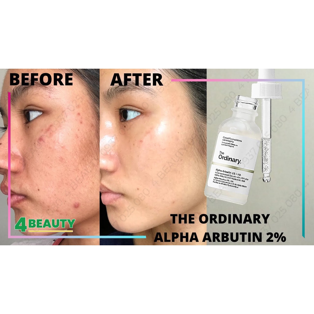 Serum The Ordinary Alpha Arbutin 2% + HA dưỡng trắng mờ thâm nám 30ml - 4 BEAUTY