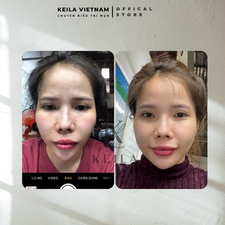 Kem Giảm Mụn KEILA