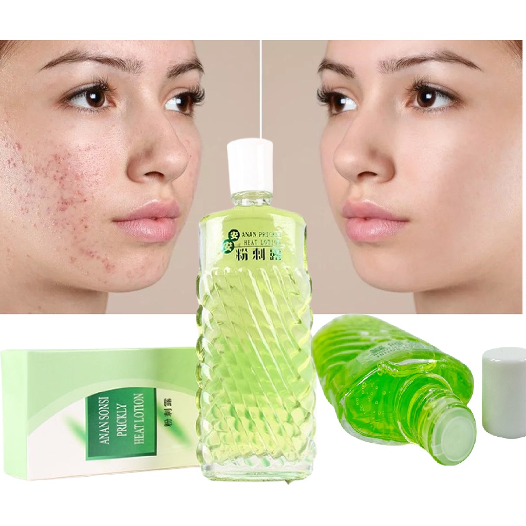 Nước Hoa Hồng Hết Mụn, Thu Nhỏ Lỗ Chân Lông Thảo Dược Thiên Nhiên ANAN Prickly Hết Mụn Thu Nhỏ Lỗ Chân Lông Chính Hãng