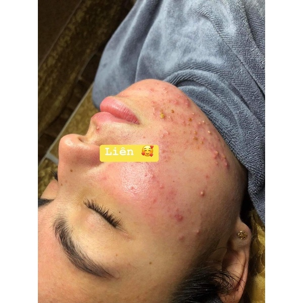 Serum Giảm Mụn Thâm Rỗ Sáng Da Skin Care Acne - Tác Dụng 5 in 1 hiệu quả qua 5 ngày trải nghiệm