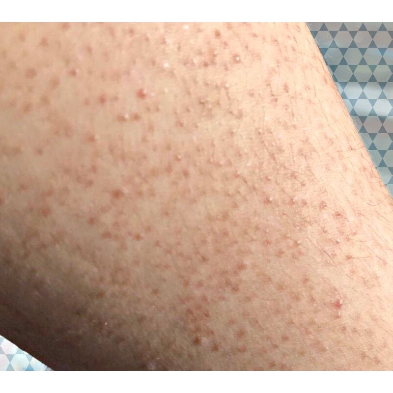 Thảo dược đánh bay Viêm lỗ chân lông, Da sần sùi, thô ráp, Lông quặp , Viêm nang lông