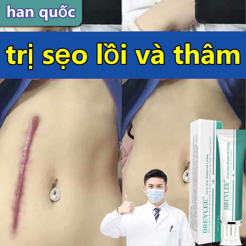 kem xóa sẹo nhanh chóng sửa chữa tất cả các loại của vết sẹo do bị thương sẹo bỏng sẹo phẫu thuật Scar Care 30g