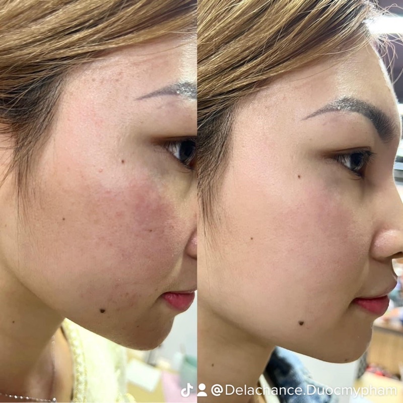 Tinh chất Home Peel cho da mụn, thâm nám, da nhạy cảm, giúp căng bóng trẻ hoá da