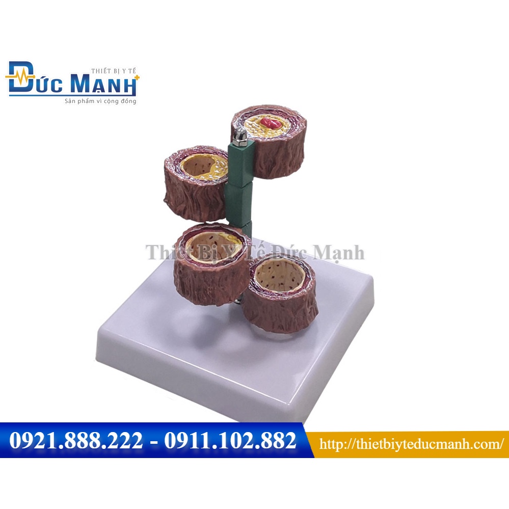 Mô hình sơ vữa động mạch qua các giai đoạn