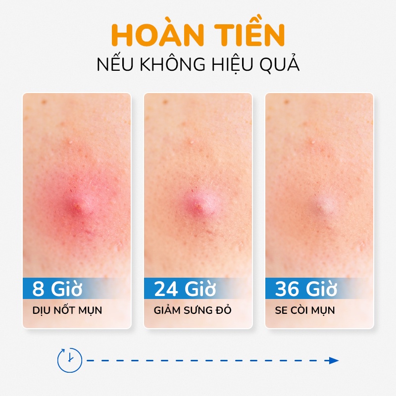 Serum Giảm Mụn Và Thâm Cấp Tốc 24H Tinh Dầu Tràm Trà Úc Anti Acnes NEOSKIN 20ml
