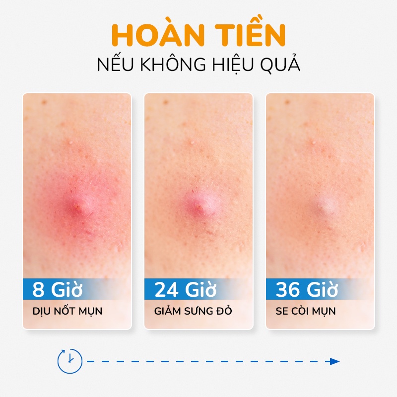 Serum Giảm Mụn Ẩn Và Thâm Cấp Tốc 24H Tinh Dầu Tràm Trà Úc Anti Acnes NEOSKIN 20ml (Chai)