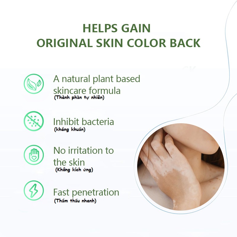 Kem Bôi da Lang Ben, Bạch Biến, Đốm Trắng, Mồ Hôi tay, thành phần thảo dược thiên nhiên 100%