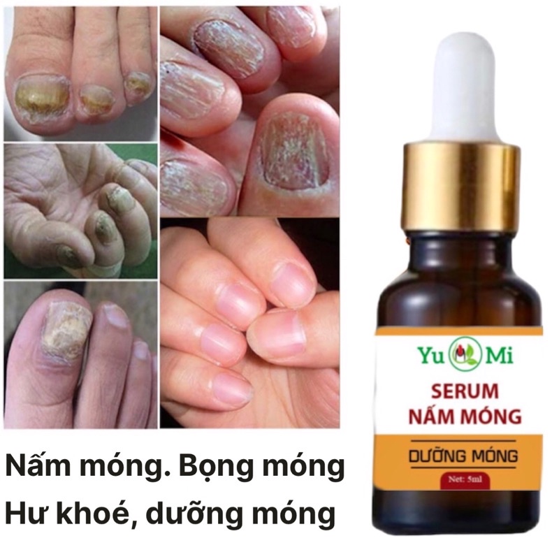 Serum Nấm Móng, Hư Khoé, Viem Mũ
