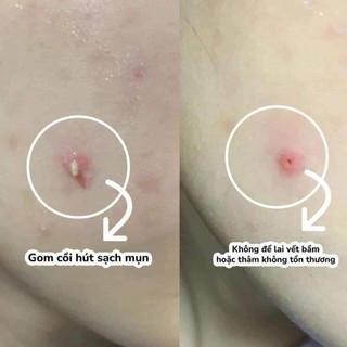 Dán Mụn COSRX Acne Pimple Master Patch 24 miếng