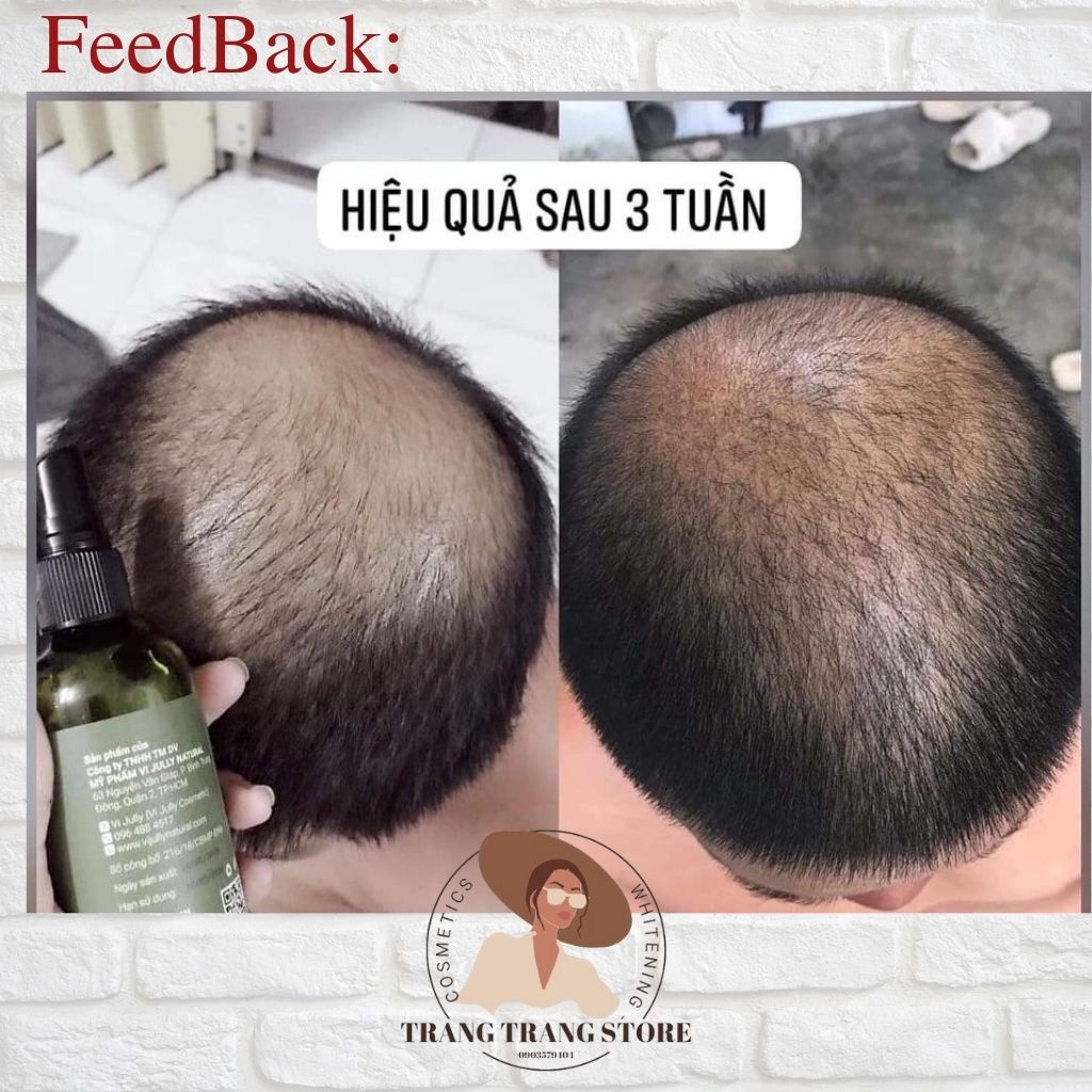 Tinh Dầu Bưởi Vijuly - Hair Lotion Giúp Giảm Rụng Tóc, Kích Thích Mọc Tóc 150Ml