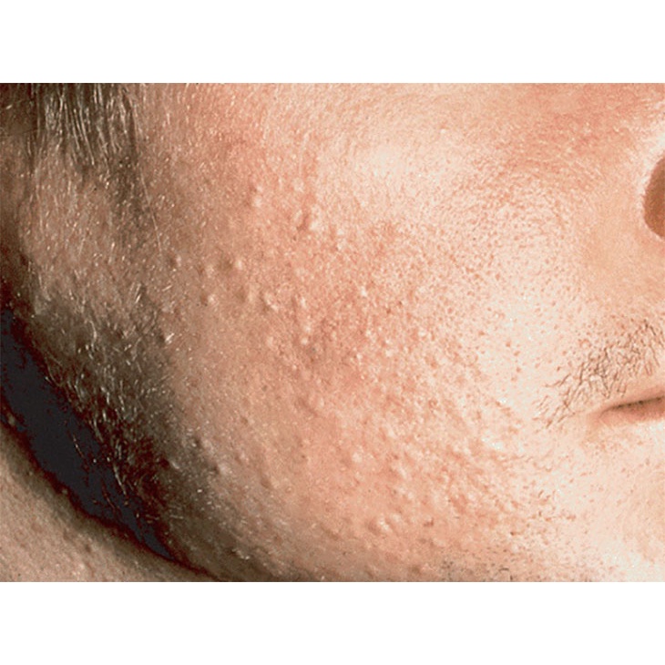 Thảo dược đánh bay Viêm lỗ chân lông, Da sần sùi, thô ráp, Lông quặp , Viêm nang lông