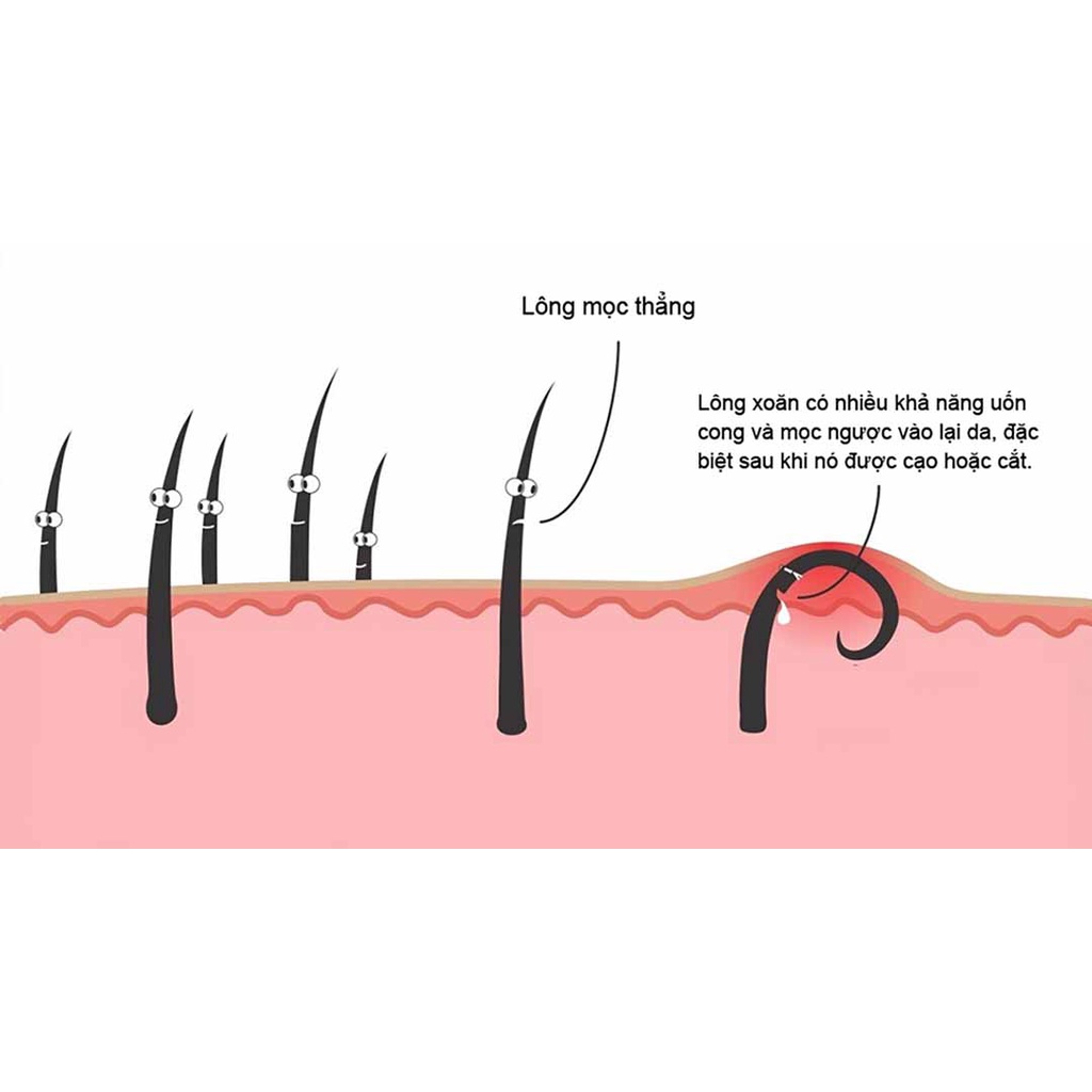 Thảo dược đánh bay Viêm lỗ chân lông, Da sần sùi, thô ráp, Lông quặp , Viêm nang lông