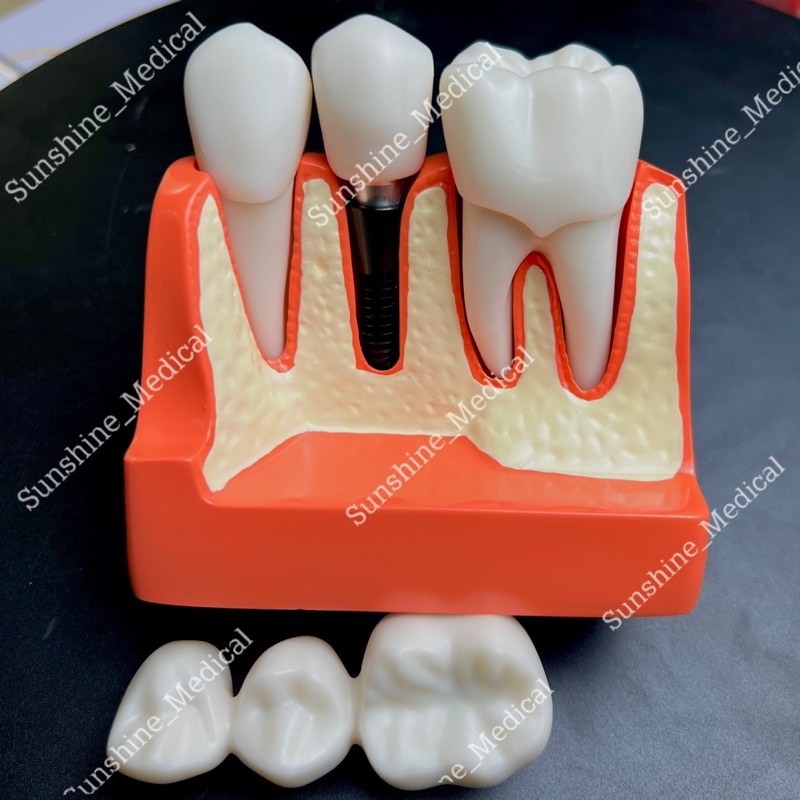 Mẫu hàm tư vấn cầu răng và implant mẫu hàm tư vấn nha khoa
