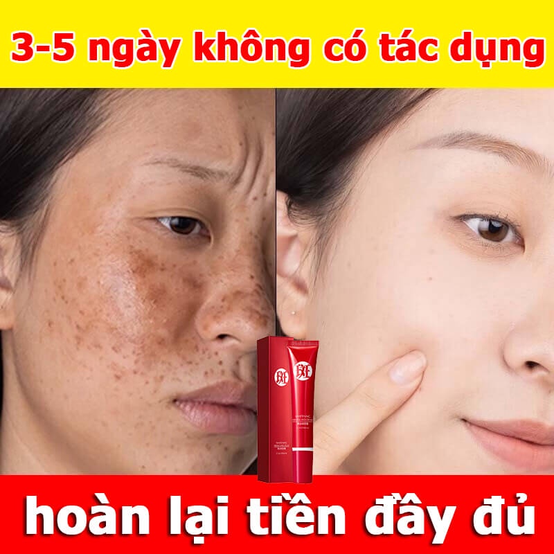 kem trắng da mặt dưỡng ẩm loại bỏ hoàn toàn đồi mồi,hắc tố,làm trắng da cải thiện làn da xỉn màu, giúp da mịn màng