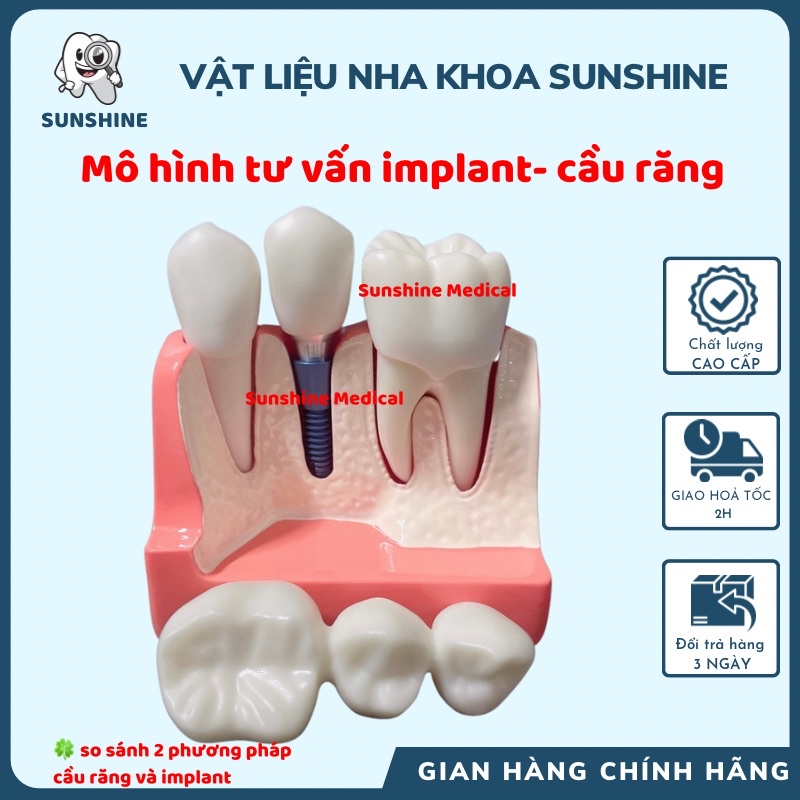 Mẫu hàm tư vấn cầu răng và implant mẫu hàm tư vấn nha khoa