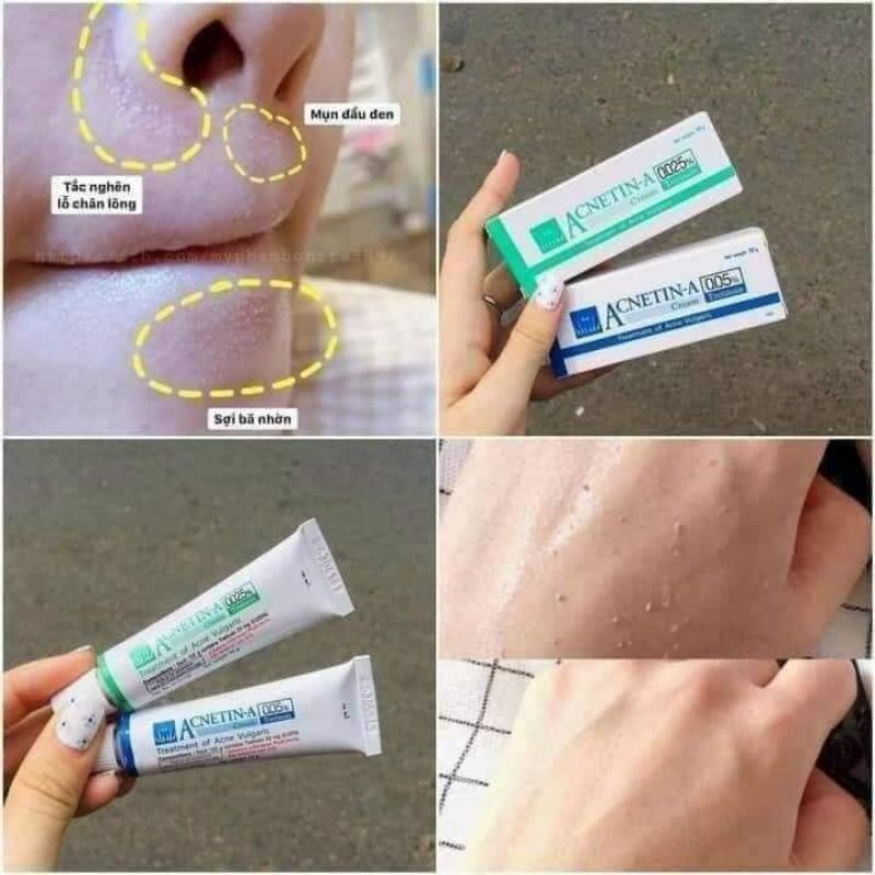 Acne tin A Tretinoin kem dưỡng da tái tạo da giảm lão hóa Thái 10g