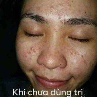 Kem chuyên mụn HUỲNH ĐỖ