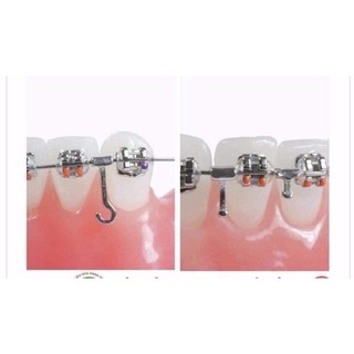 HOOK CHỈNH NHA (hook trái, hook phải, hook thẳng, hook 3 móc)