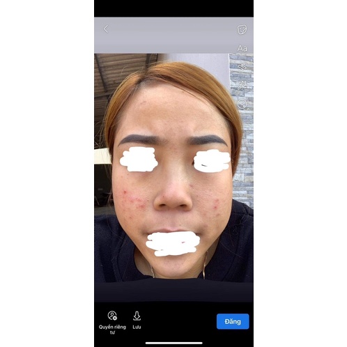 Serum Giảm Mụn Thâm Rỗ Sáng Da Skin Care Acne - Tác Dụng 5 in 1 hiệu quả qua 5 ngày trải nghiệm