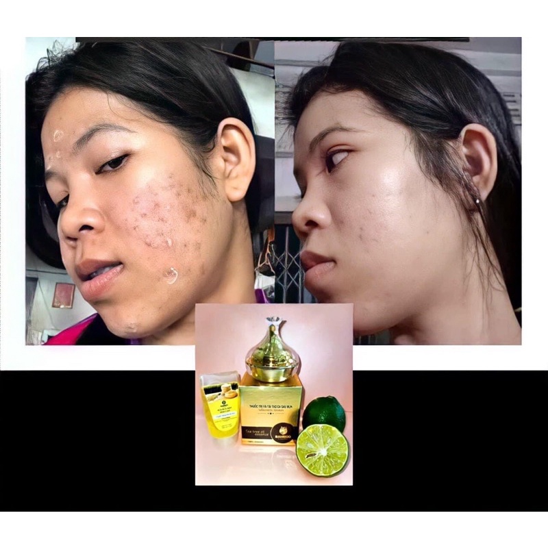 Kem Mụn Bamboo tặng sữa rửa mặt hoa gạo bamboo