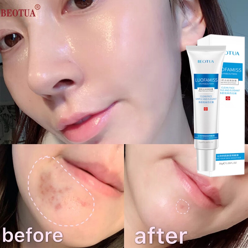 🔥Kem Hết Mụn skin acne gel mụn Kem chấm mụn thâm cấp tốc cho nam giới nữ giới Xóa thâm Kem mụn giúp dưỡng trắng da xóa thâm liền sẹo Kiểm Soát Dầu Dưỡng ẩm và Nuôi giảm vết thâm mụn