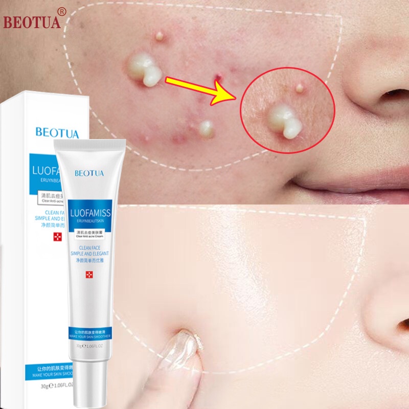 🔥Kem Hết Mụn skin acne gel mụn Kem chấm mụn thâm cấp tốc cho nam giới nữ giới Xóa thâm Kem mụn giúp dưỡng trắng da xóa thâm liền sẹo Kiểm Soát Dầu Dưỡng ẩm và Nuôi giảm vết thâm mụn