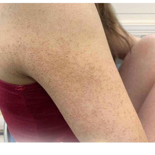 Thảo dược đánh bay Viêm lỗ chân lông, Da sần sùi, thô ráp, Lông quặp , Viêm nang lông