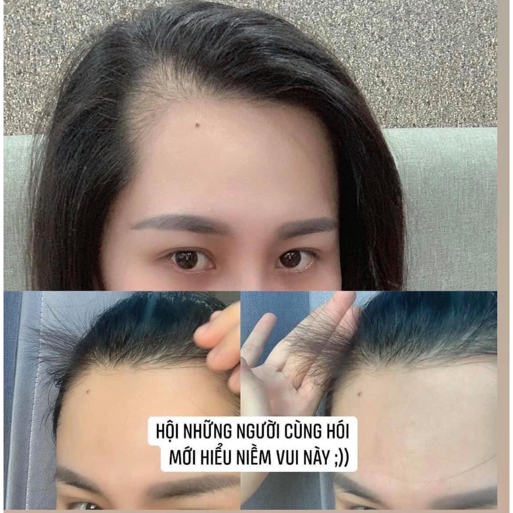Xịt Mọc Tóc Minoxidil Bailleul 2%, 5% Pháp, Giảm Rụng Tóc Và Kích Thích Mọc Tóc