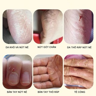 Kem nứt gót chân ngựa