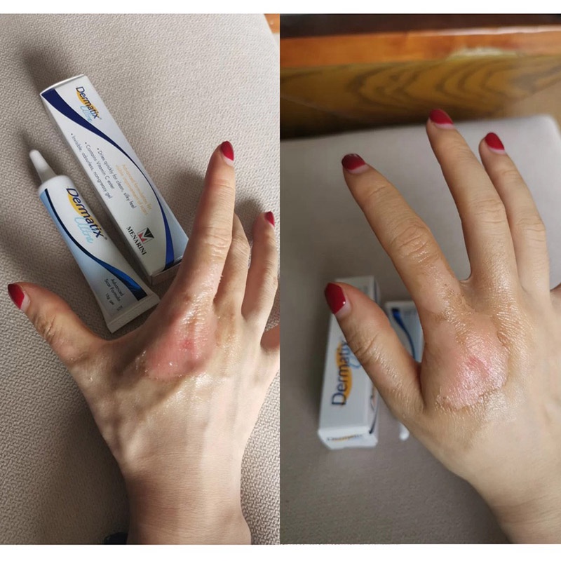 Dermatix Ultra Gel Làm Mờ Sẹo Thâm, Sẹo Lồi 15g Vết sẹo kem