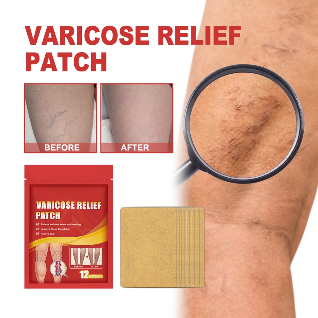 Miếng dán giảm giãn tĩnh mạch 12 miếng sửa chữa tĩnh mạch chân phồng lên bằng giun đất sưng đau chân